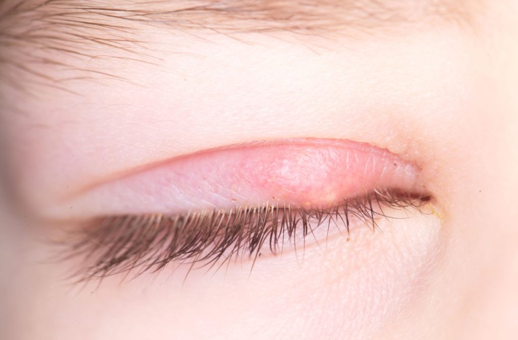 A close-up image of an eye with a small stye on the upper eyelid.